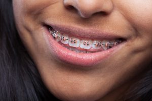 latin girl's mouth with brackets latin girl's mouth with brackets